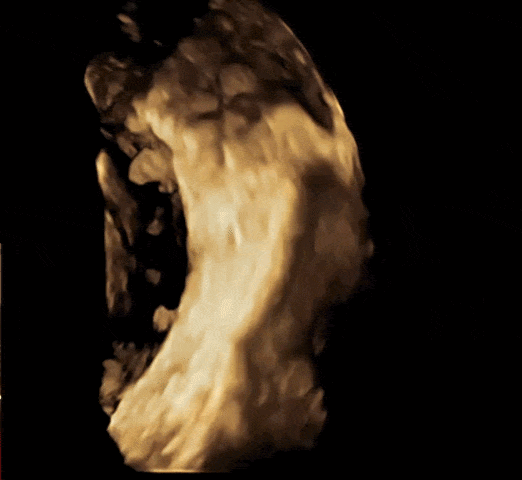 Benign and malignant adnexal tumors